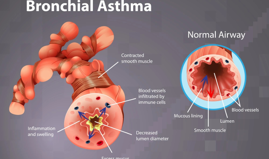 Asthma